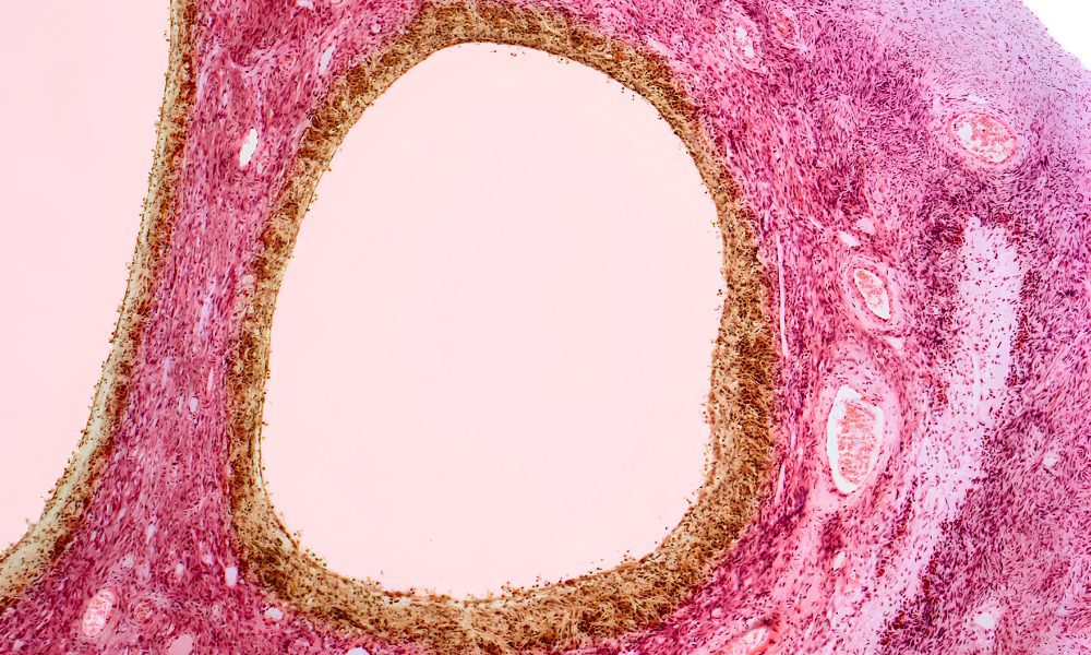 PCOS Renamed to PMOS: Why the World Changed the Name of One of the Most Misunderstood Women’s Health Conditions